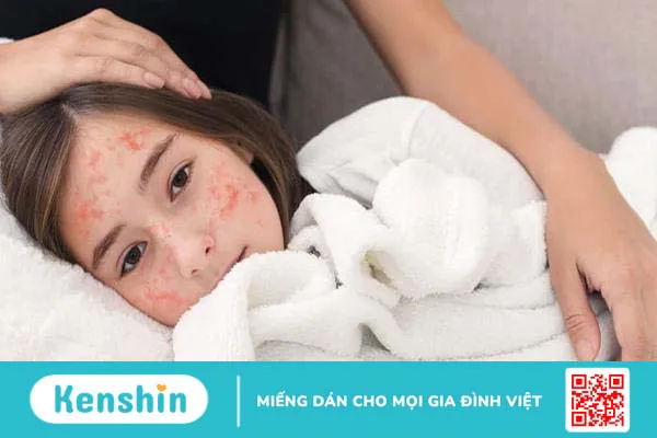 10 nguyên nhân sốt phát ban phổ biến ở trẻ em cần lưu ý