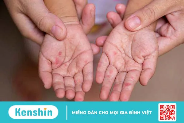 10 nguyên nhân sốt phát ban phổ biến ở trẻ em cần lưu ý