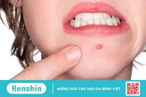 11 sai lầm khi nặn mụn khiến da bạn dễ bị sẹo