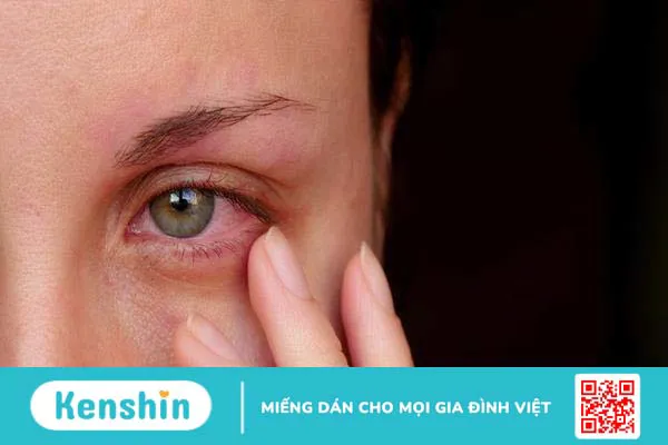 11 triệu chứng bệnh viêm khớp vảy nến không thể bỏ qua