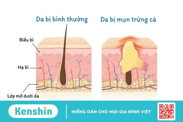 3 phương pháp trị mụn trứng cá từ cơ bản đến chuyên sâu