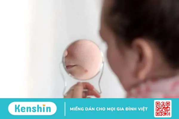 4 nguyên nhân mọc mụn quanh miệng bạn không ngờ tới