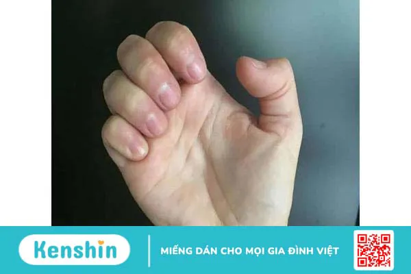 5 bài tập giúp giảm cứng khớp ngón tay hiệu quả