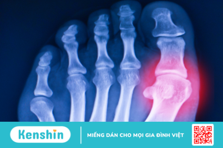 5 bệnh lý và chấn thương thường gặp ở ngón chân