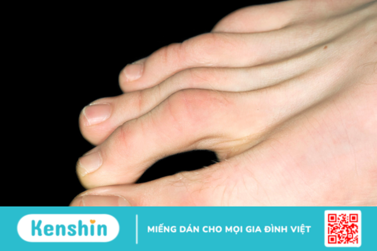 5 bệnh lý và chấn thương thường gặp ở ngón chân
