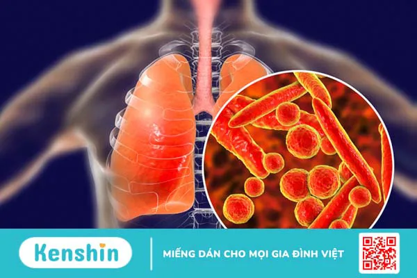 5 nguyên nhân viêm phổi mà bạn cần nhận biết