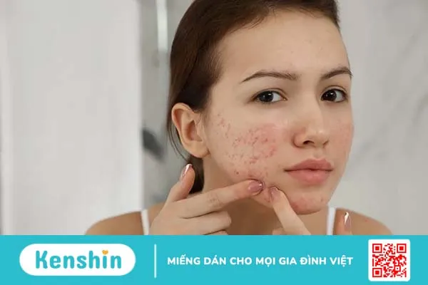 6 bước chăm sóc da mụn và thâm “chuẩn” cho da rạng ngời