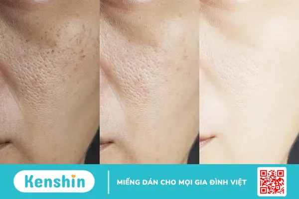 6 loại serum chứa Niacinamide kiểm soát dầu, mụn – cho làn da luôn căng mịn