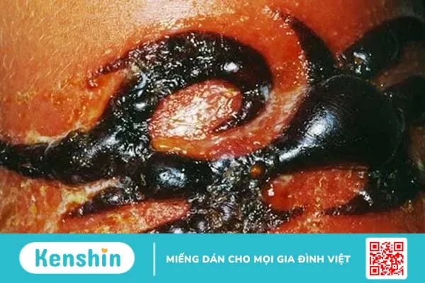 9 vấn đề thường gặp khi xăm hình và cách khắc phục hiệu quả