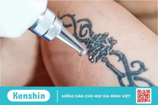 9 vấn đề thường gặp khi xăm hình và cách khắc phục hiệu quả