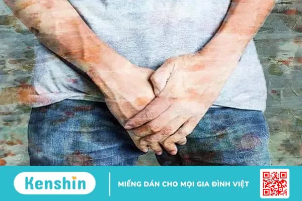 Bạch biến dương vật và những thông tin cần biết