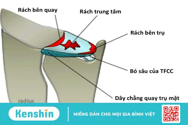 Bạn biết gì về đau cổ tay bên trụ?