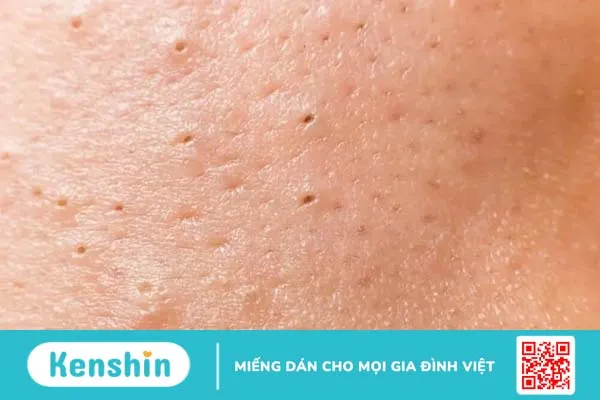 Bạn đã nặn mụn đúng cách chưa? Cùng tìm hiểu nhé!