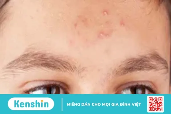 Bạn đã nặn mụn đúng cách chưa? Cùng tìm hiểu nhé!