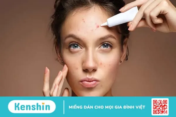 Bạn đã nặn mụn đúng cách chưa? Cùng tìm hiểu nhé!