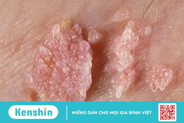 Bạn nên làm gì khi phát hiện dấu hiệu sùi mào gà ở nữ?