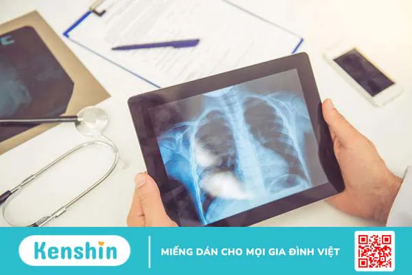 Bật mí các cách điều trị viêm phổi giúp bạn nhanh khỏe