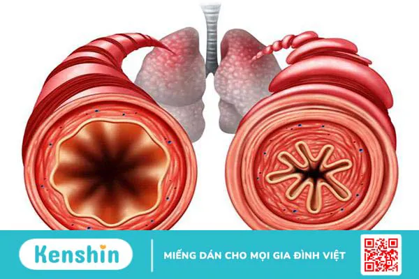 Bật mí các cách trị thở khò khè ở người lớn tại nhà đơn giản, hiệu quả