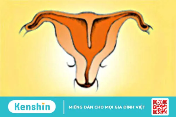 Bất thường ở tử cung ảnh hưởng đến khả năng sinh sản