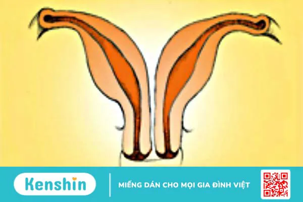 Bất thường ở tử cung ảnh hưởng đến khả năng sinh sản