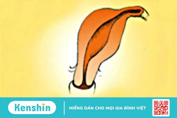 Bất thường ở tử cung ảnh hưởng đến khả năng sinh sản