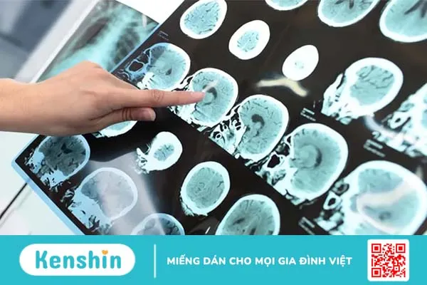 Bệnh Alzheimer là gì? Nguyên nhân, triệu chứng và điều trị