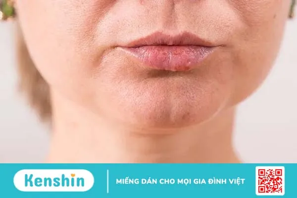 Bệnh giang mai có lây qua nước bọt không? Triệu chứng khi mắc bệnh