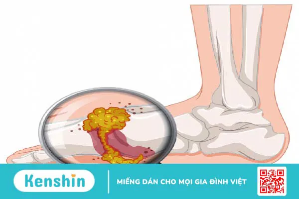 Bệnh gút là gì? Làm sao phát hiện dấu hiệu bệnh gút?