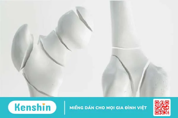 Bệnh nhân hen suyễn có nguy cơ bị loãng xương rất cao