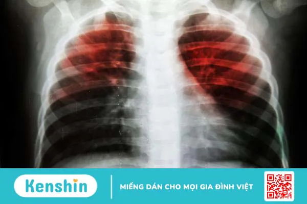 Bệnh phổi kẽ – Nguyên nhân, triệu chứng và cách điều trị