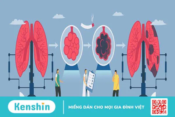 Bệnh phổi tắc nghẽn mạn tính sống được bao lâu đối với mỗi giai đoạn?