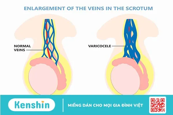 Bệnh sa bìu ở nam giới có thể đến từ nguyên nhân nguy hiểm