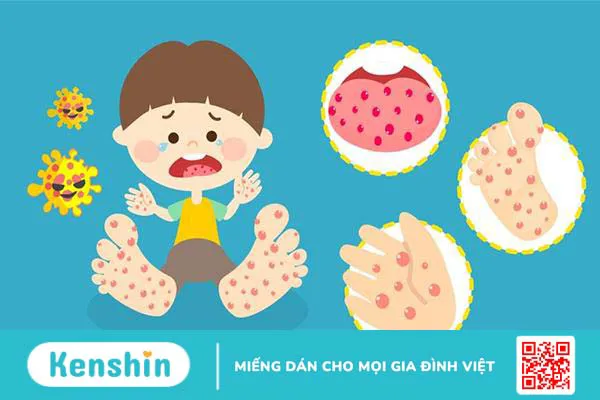 Bệnh tay chân miệng có lây không? Lây qua những đường nào?