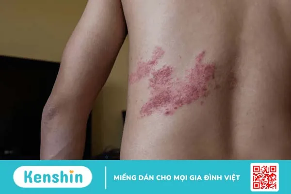 Bệnh zona thần kinh có lây không?