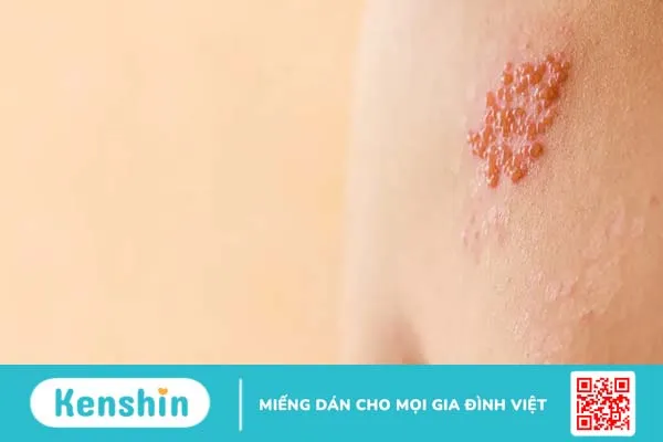 Bệnh zona thần kinh (giời leo) là gì? Mức độ nguy hiểm và cách điều trị