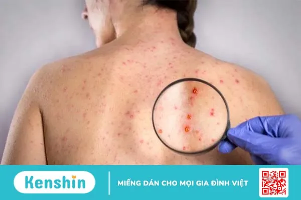 Bệnh zona thần kinh (giời leo) là gì? Mức độ nguy hiểm và cách điều trị