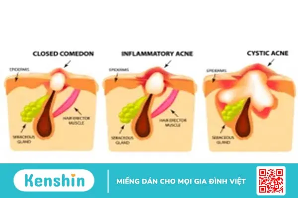 Bị mụn bọc có để lại sẹo? Đâu là cách trị mụn bọc hiệu quả?