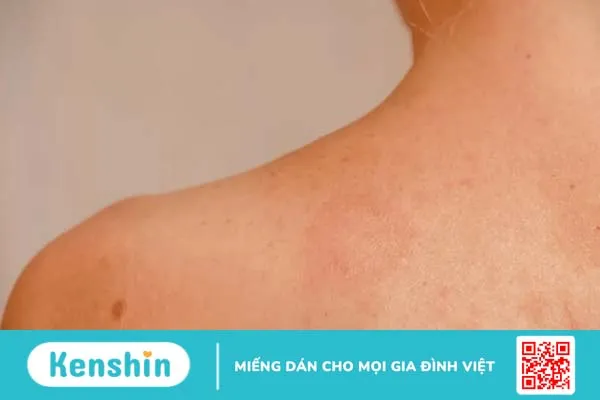 Bị nổi vòng tròn đỏ trên da là bệnh gì?