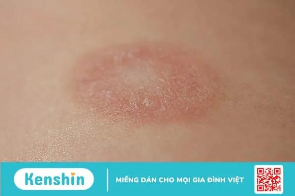 Bị nổi vòng tròn đỏ trên da là bệnh gì?