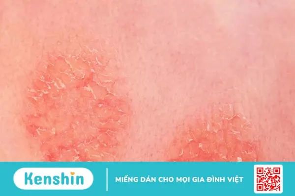 Bị nổi vòng tròn đỏ trên da là bệnh gì?