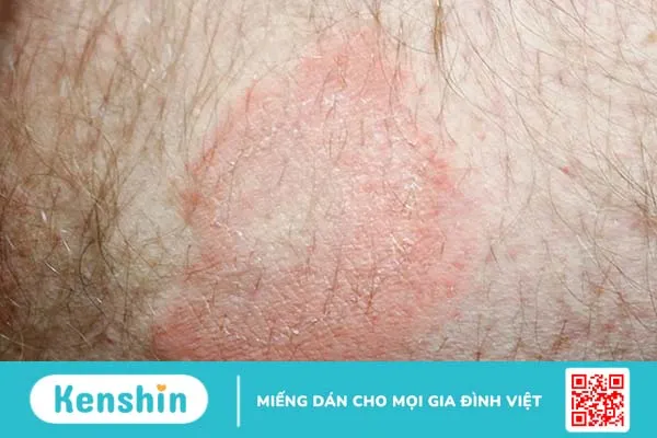 Bị nổi vòng tròn đỏ trên da là bệnh gì?