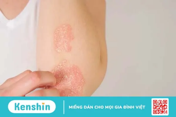 Bị nổi vòng tròn đỏ trên da là bệnh gì?