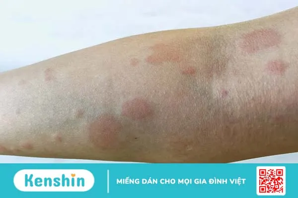 Bị nổi vòng tròn đỏ trên da là bệnh gì?