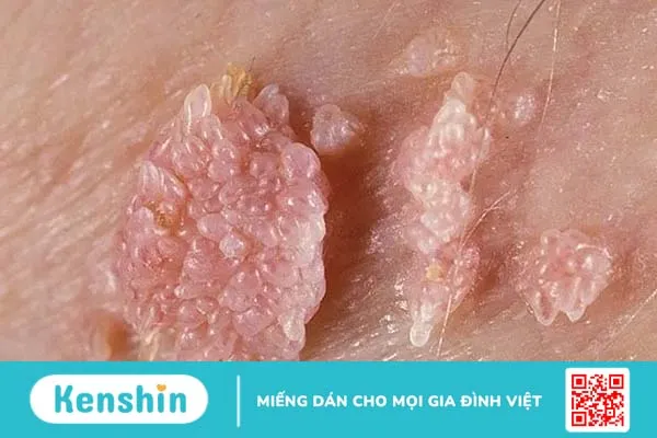 Bị sùi mào gà có ngứa không?