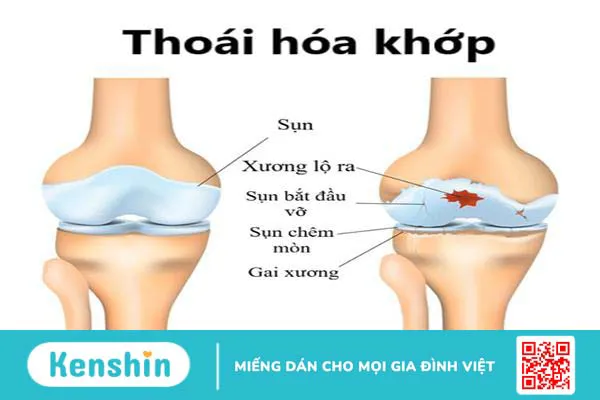 Biến chứng do thoái hóa khớp: Đừng xem thường!