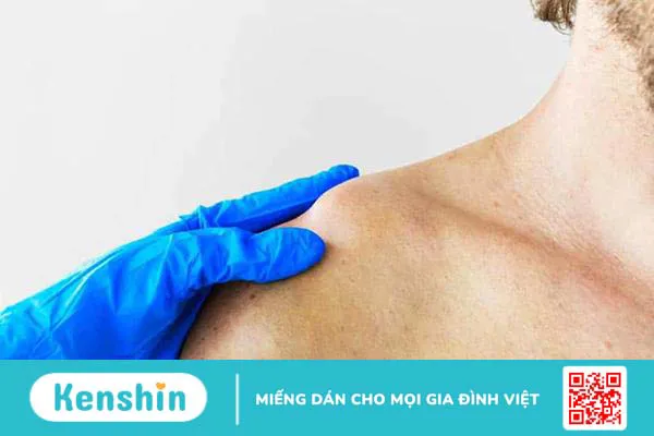 Biến chứng gãy xương đòn là gì, có nguy hiểm không?