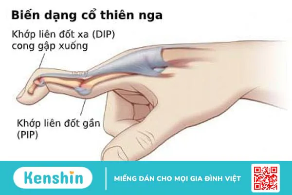 Biến dạng cổ thiên nga