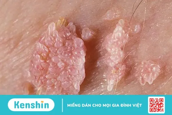 Biểu hiện sùi mào gà: Hiểu rõ để điều trị bệnh hiệu quả