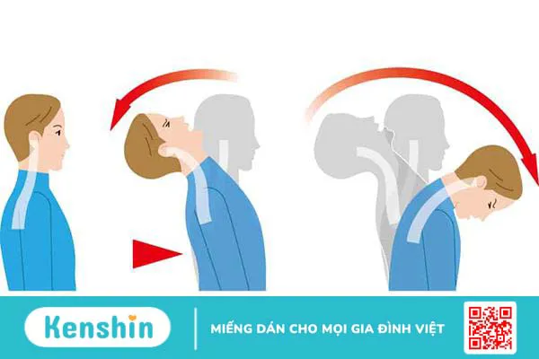 Bong gân cổ: dấu hiệu nhận biết và cách để nhanh hồi phục