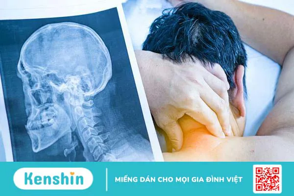 Bong gân cổ: dấu hiệu nhận biết và cách để nhanh hồi phục